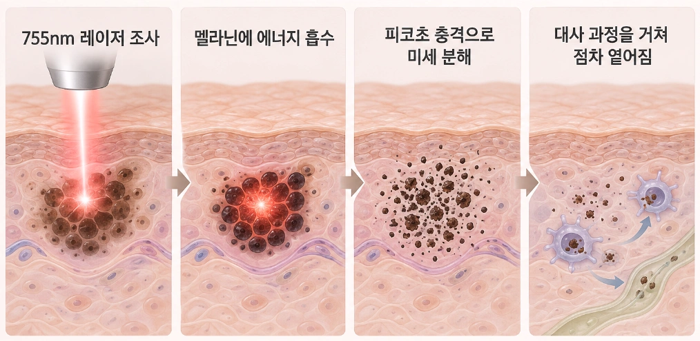 755nm 피코 레이저가 멜라닌에 흡수된 뒤 피코초 충격으로 색소를 미세 분해하고 대사 과정을 거쳐 옅어지는 원리를 나타낸 모식도