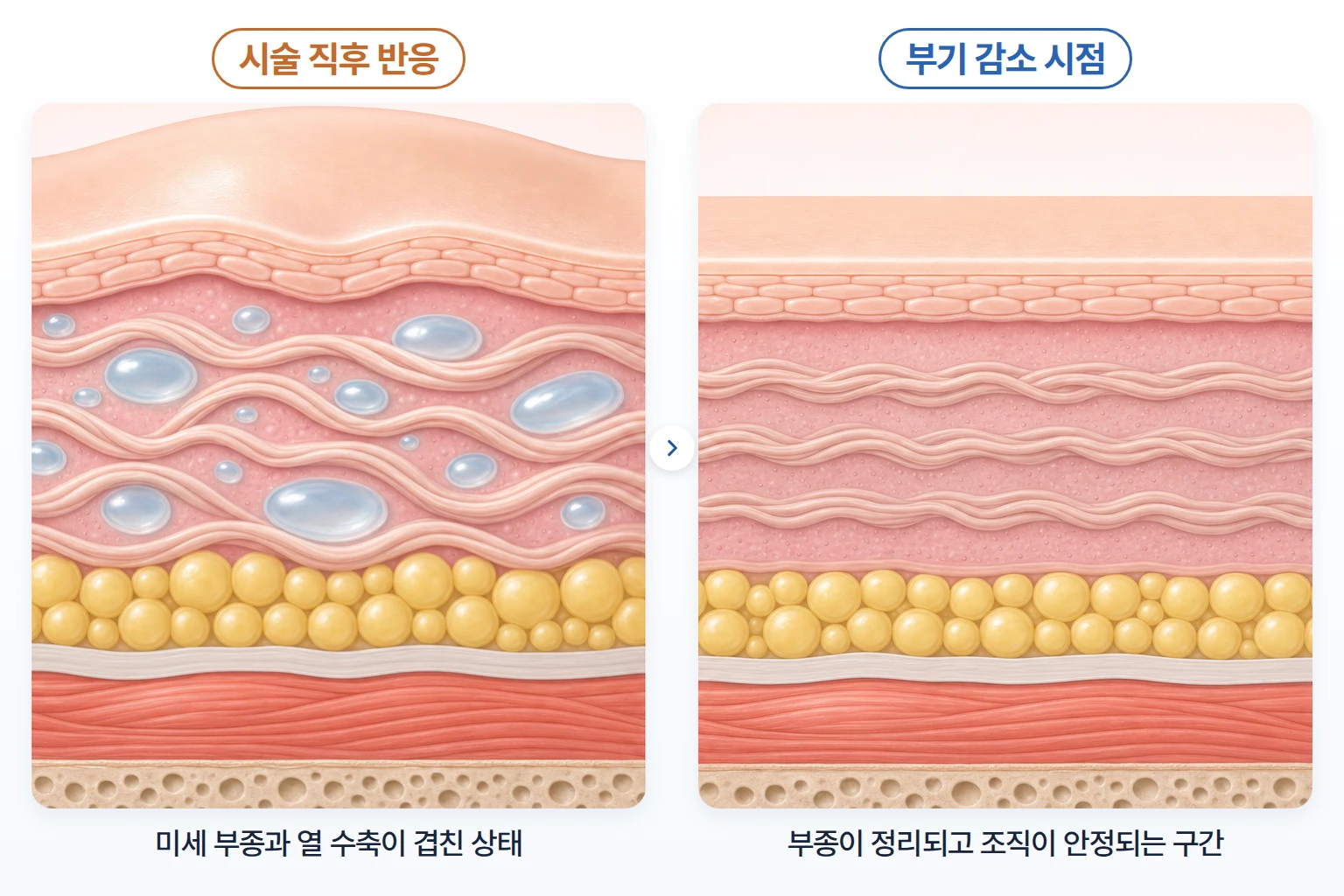 미세 부종으로 차오른 피부와 부기가 가라앉은 피부를 동일 배율로 비교한 단면 일러스트