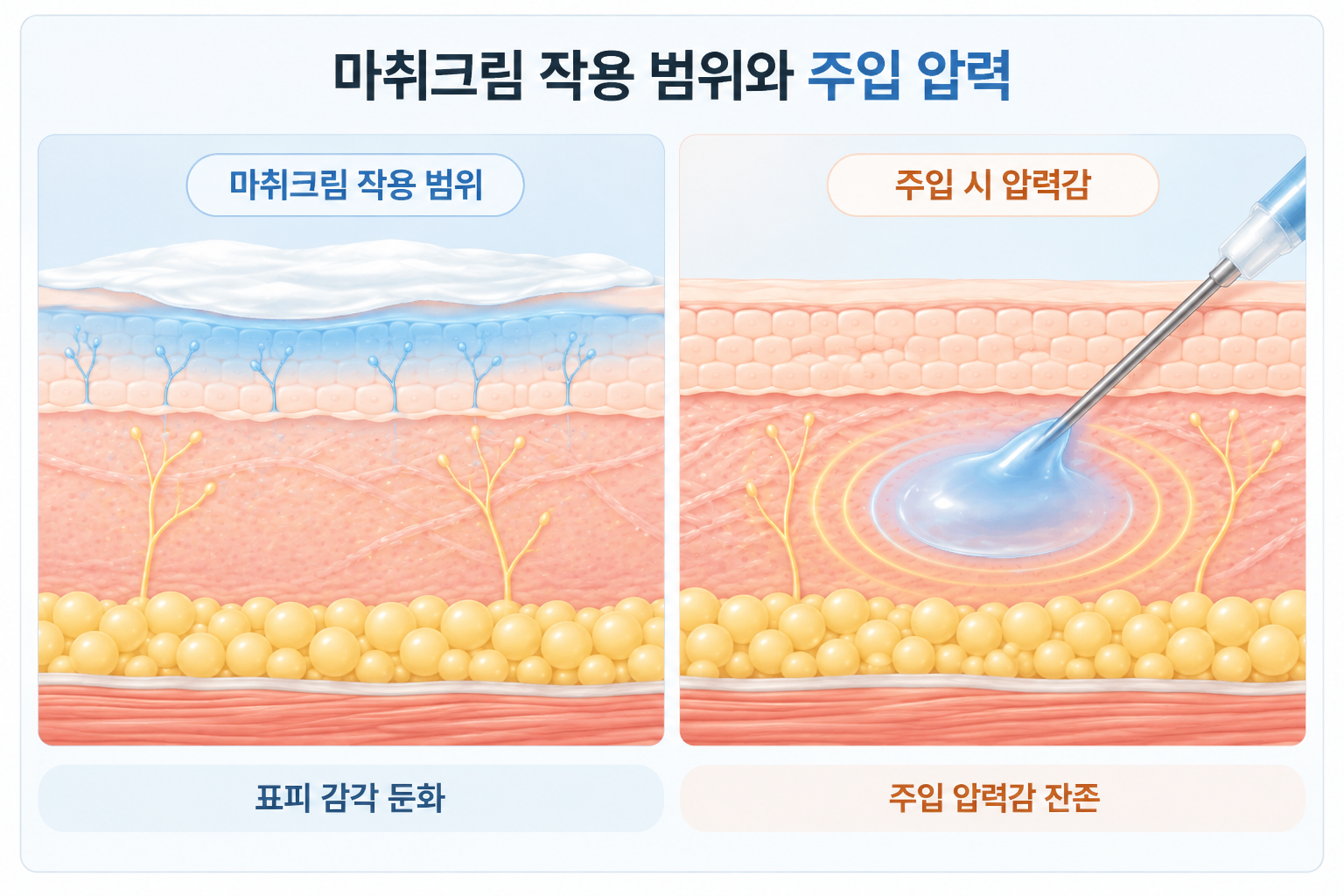 리쥬란 통증 완화를 위한 마취크림 작용 범위와 피부 조직 내 약물 주입 시 압력감 비교