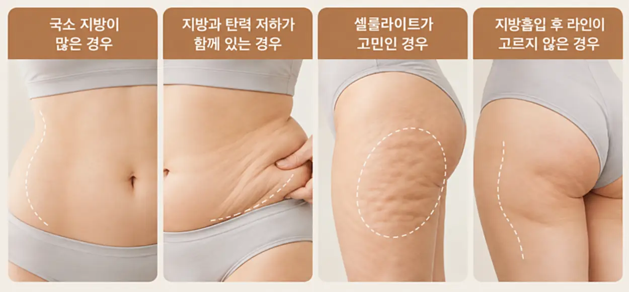 바디 인모드 FX 효과가 잘 나타나는 대상과 국소 지방이 많은 복부, 지방과 탄력 저하가 동반된 복부, 셀룰라이트가 있는 허벅지, 지방흡입 후 라인이 고르지 않은 부위를 비교한 이미지