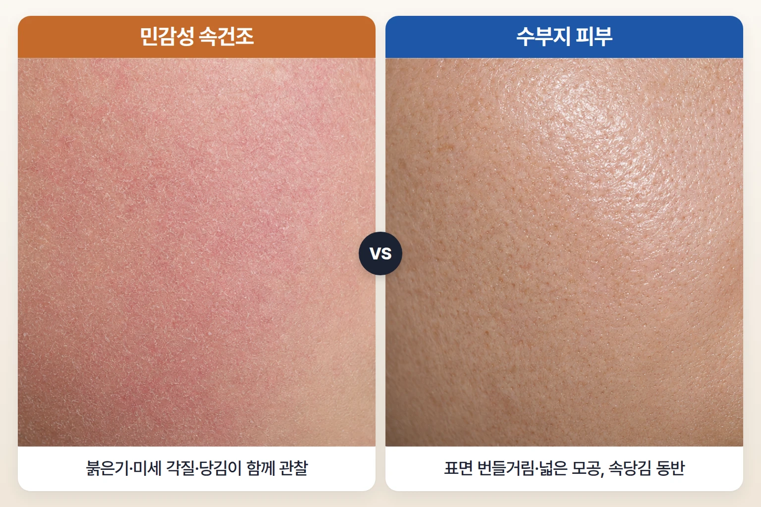 붉은기와 미세 각질이 보이는 민감성 속건조 피부와 번들거리는 수부지 피부 표면을 확대해 비교한 사진