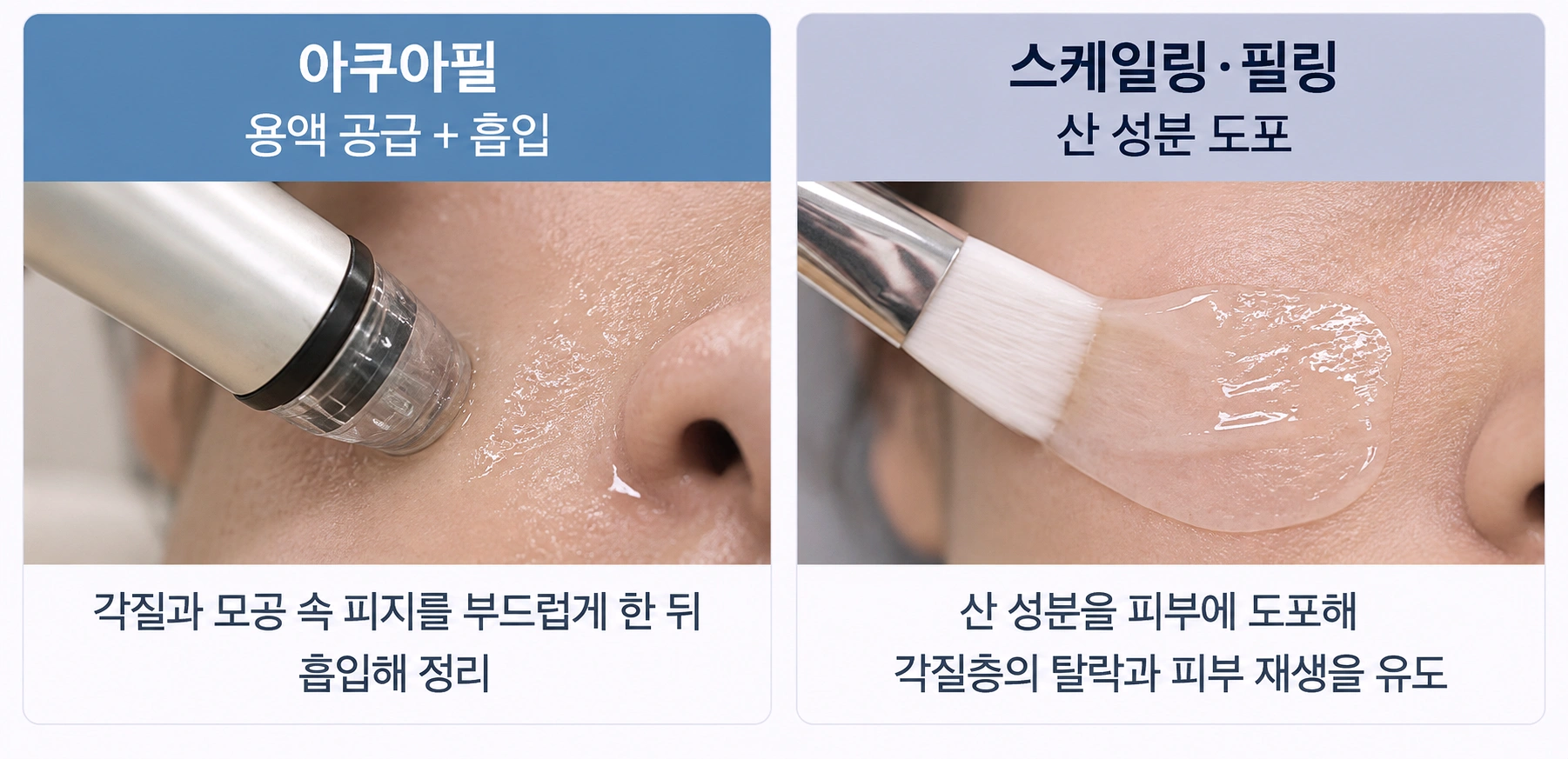 아쿠아필과 스케일링·필링의 작용 방식 차이