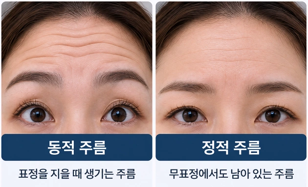 표정을 지을 때 나타나는 동적 이마주름과 무표정에서도 남아 있는 정적 이마주름의 차이를 비교한 이마주름 유형 비교 사진