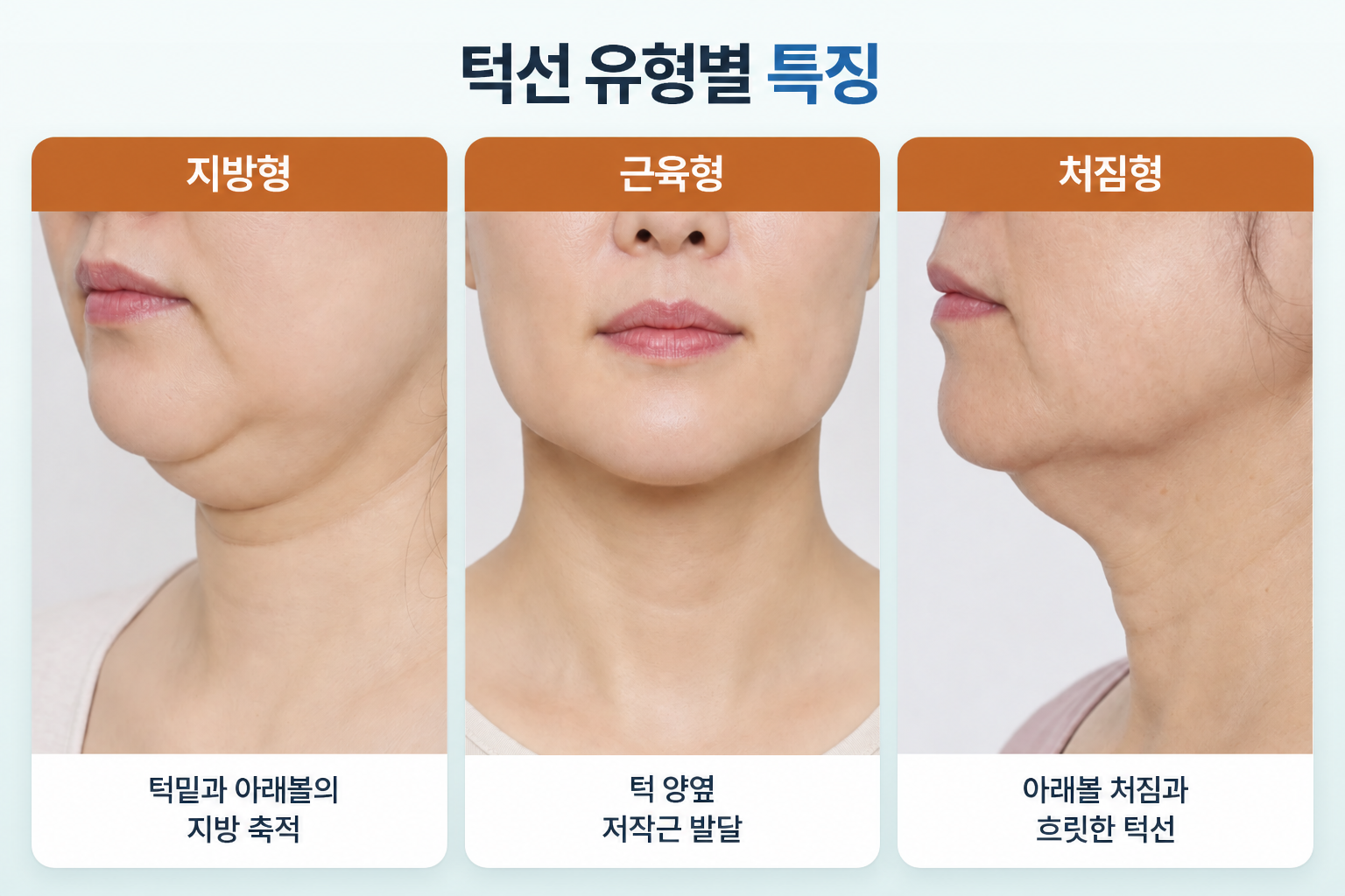 브이라인 시술 선택을 위한 지방형의 턱밑 지방 축적, 근육형의 턱 양옆 발달, 처짐형의 아래볼 처짐과 흐릿한 턱선 비교