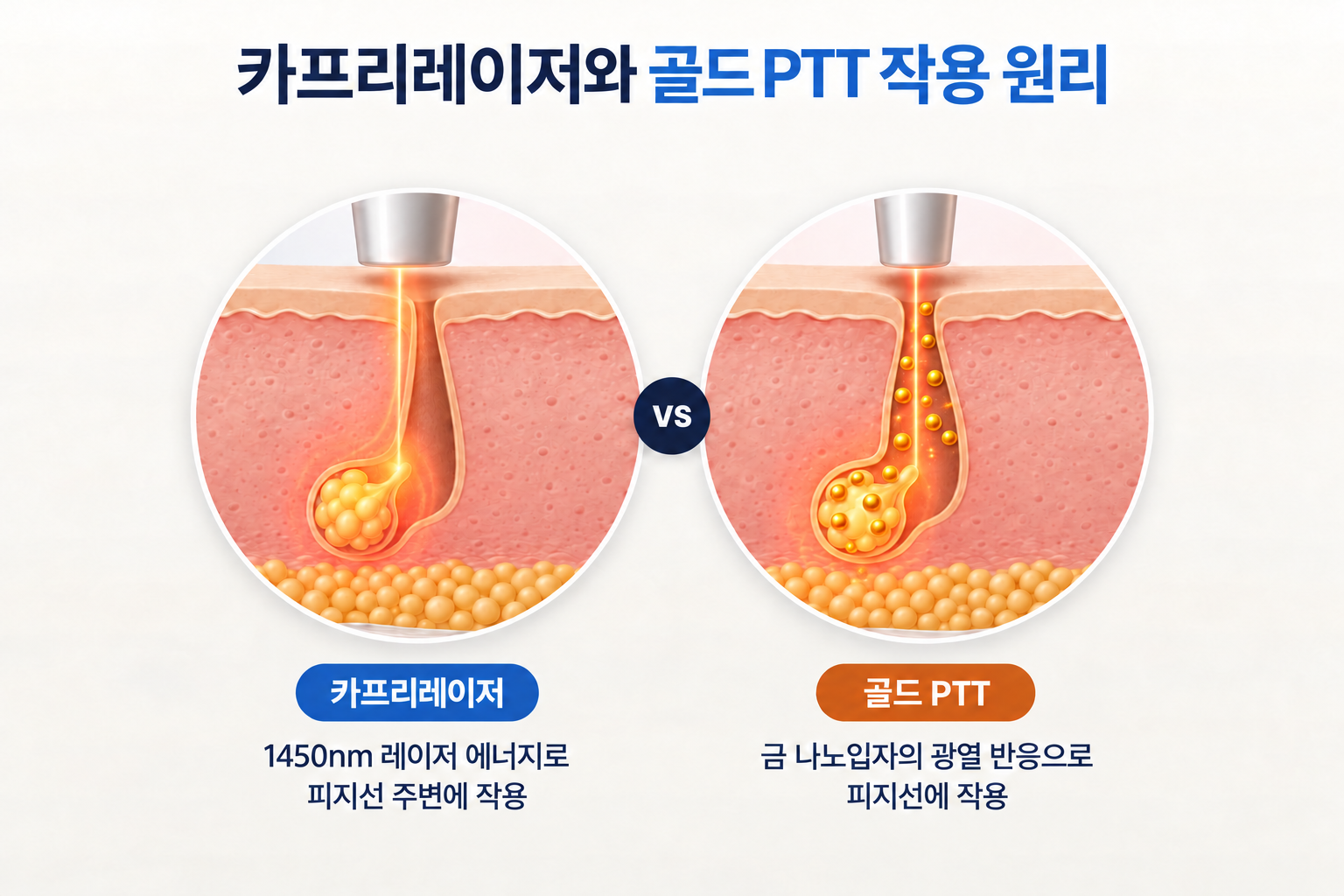 카프리레이저의 1450nm 레이저 에너지 전달과 골드 PTT의 금 나노입자 광열 반응에 따른 피지선 치료 원리 비교