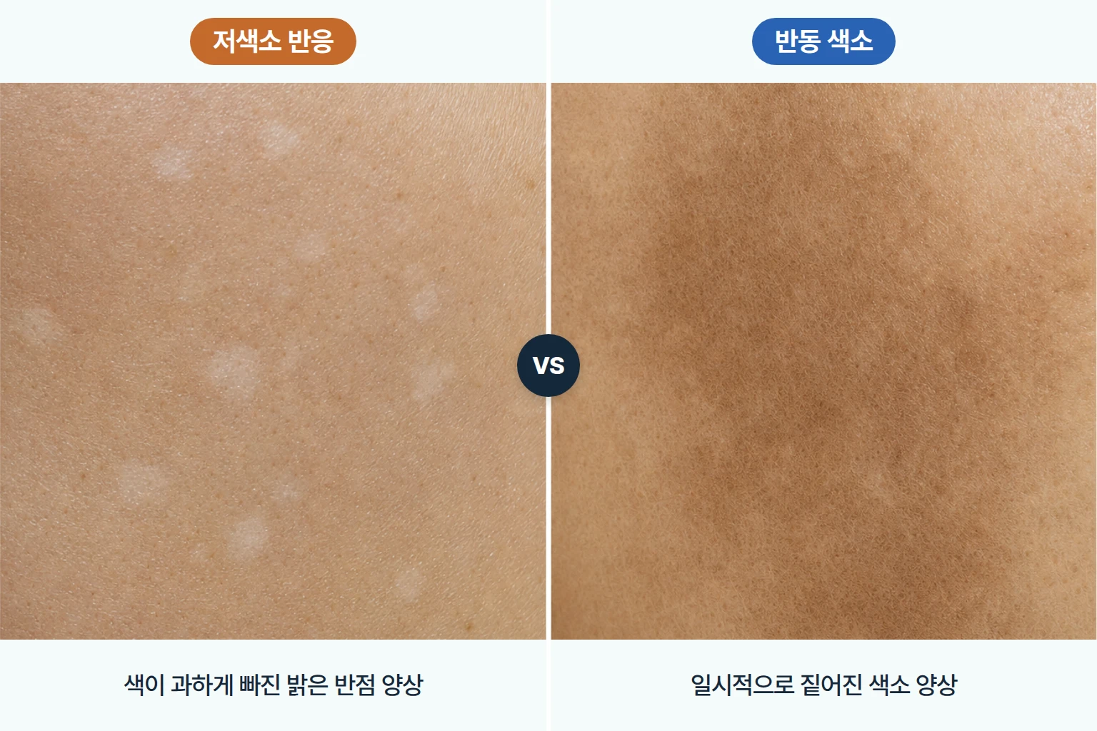 색이 과하게 빠진 저색소 반응과 일시적으로 짙어진 반동 색소를 비교한 피부 확대 사진