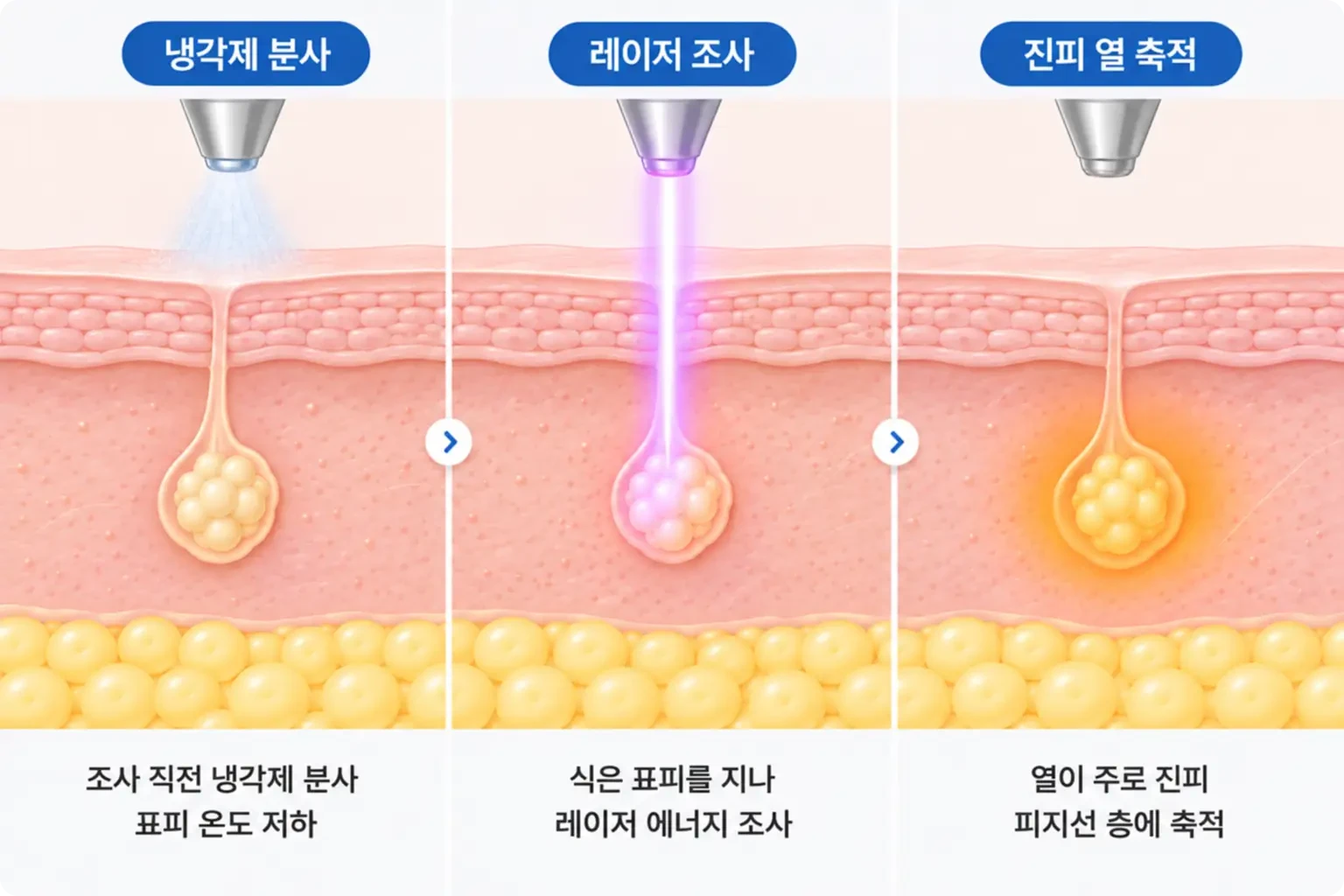 냉각제 분사, 레이저 조사, 진피 열 축적 순서로 표피 보호 원리를 3단계로 나타낸 개념도