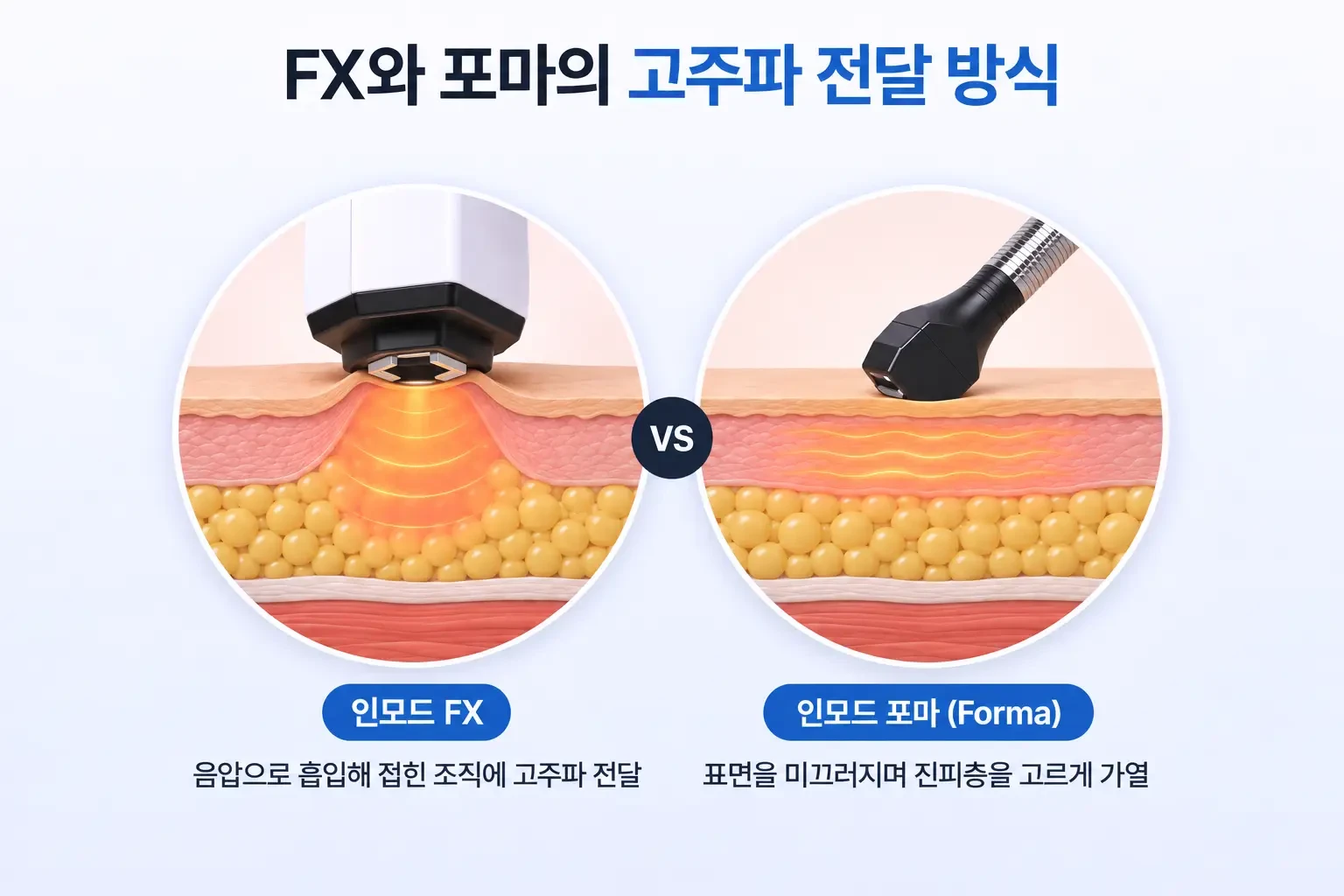음압으로 피부를 접어 올리는 FX와 표면을 미끄러지는 포마의 고주파 전달 방식 비교 일러스트