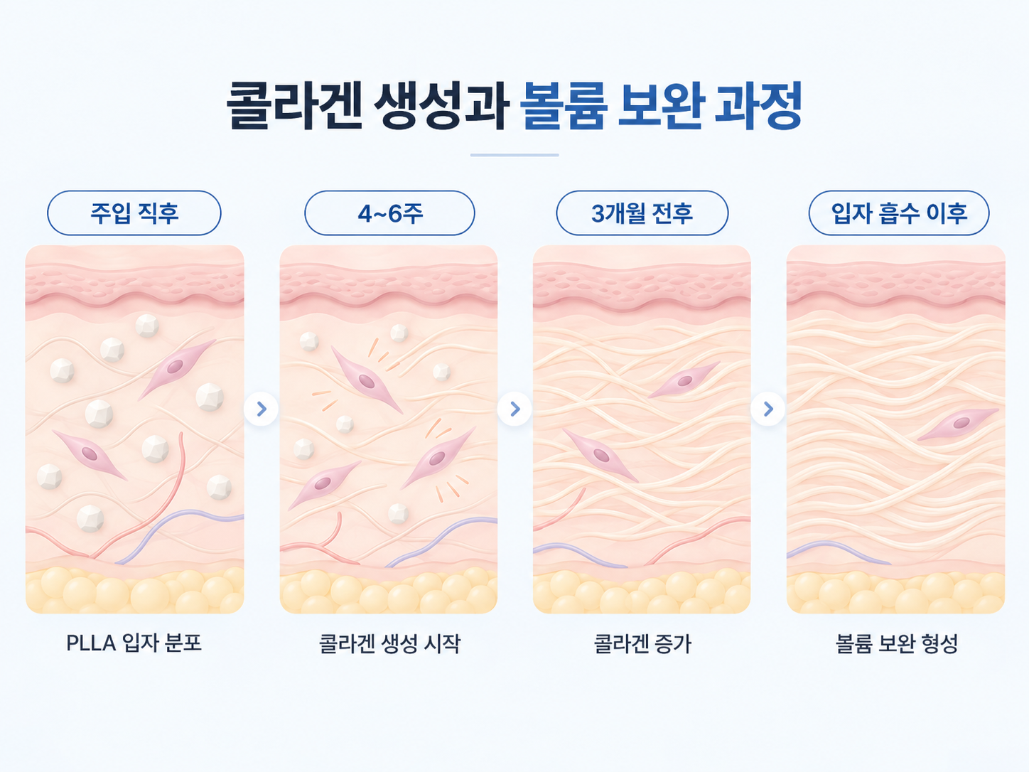 PLLA 미세입자 분포 후 콜라겐 생성과 볼륨 변화 과정