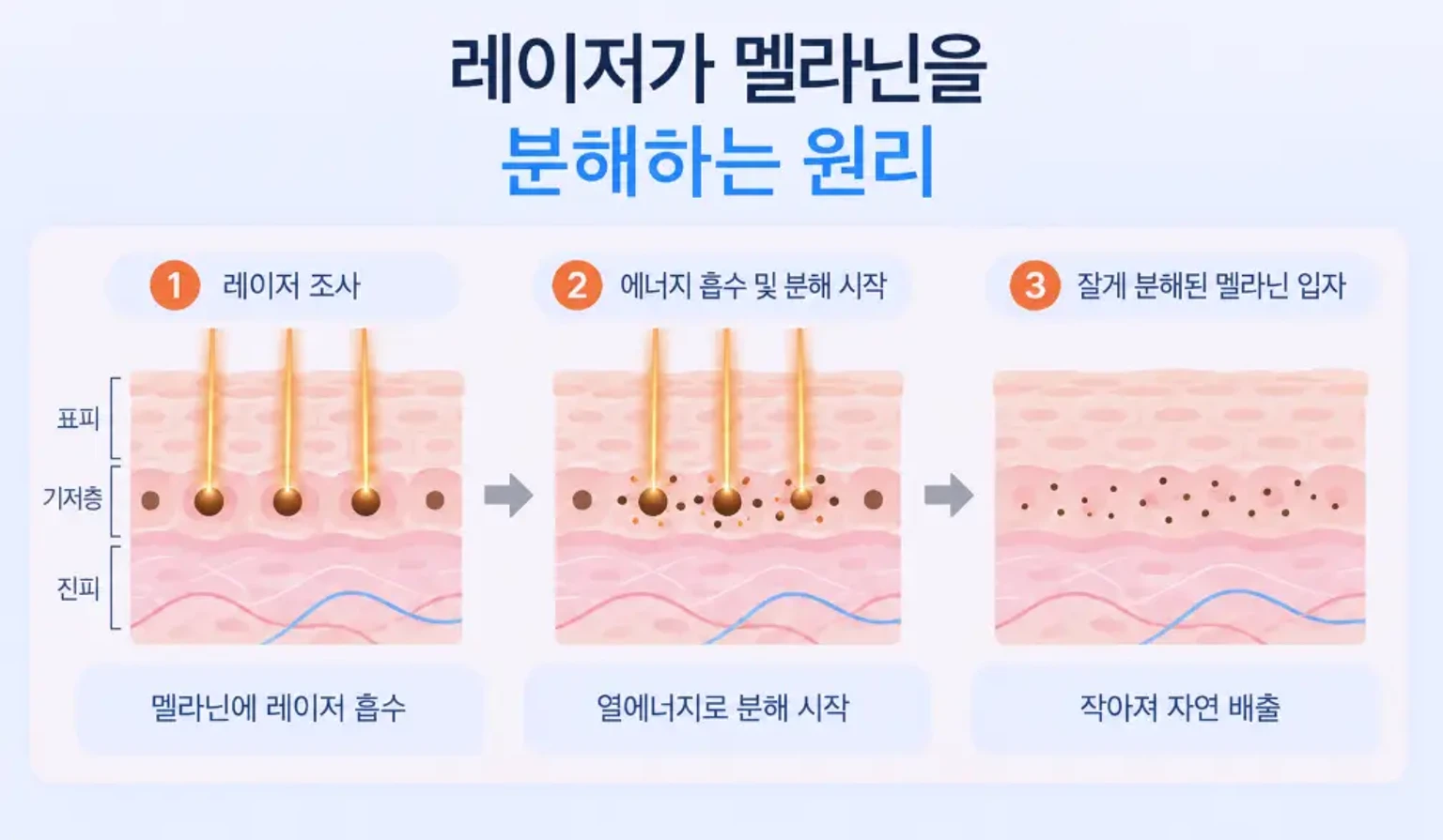 표피 기저층 멜라닌 입자에 레이저 에너지가 흡수되어 색소가 잘게 나뉘는 과정을 확대한 원리 일러스트