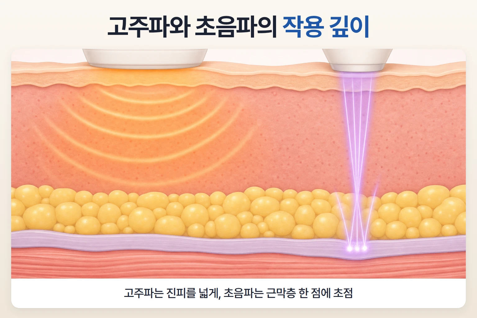 고주파 열이 진피에 넓게 퍼지고 초음파가 근막층 한 점에 모이는 깊이 차이를 그린 단면 일러스트