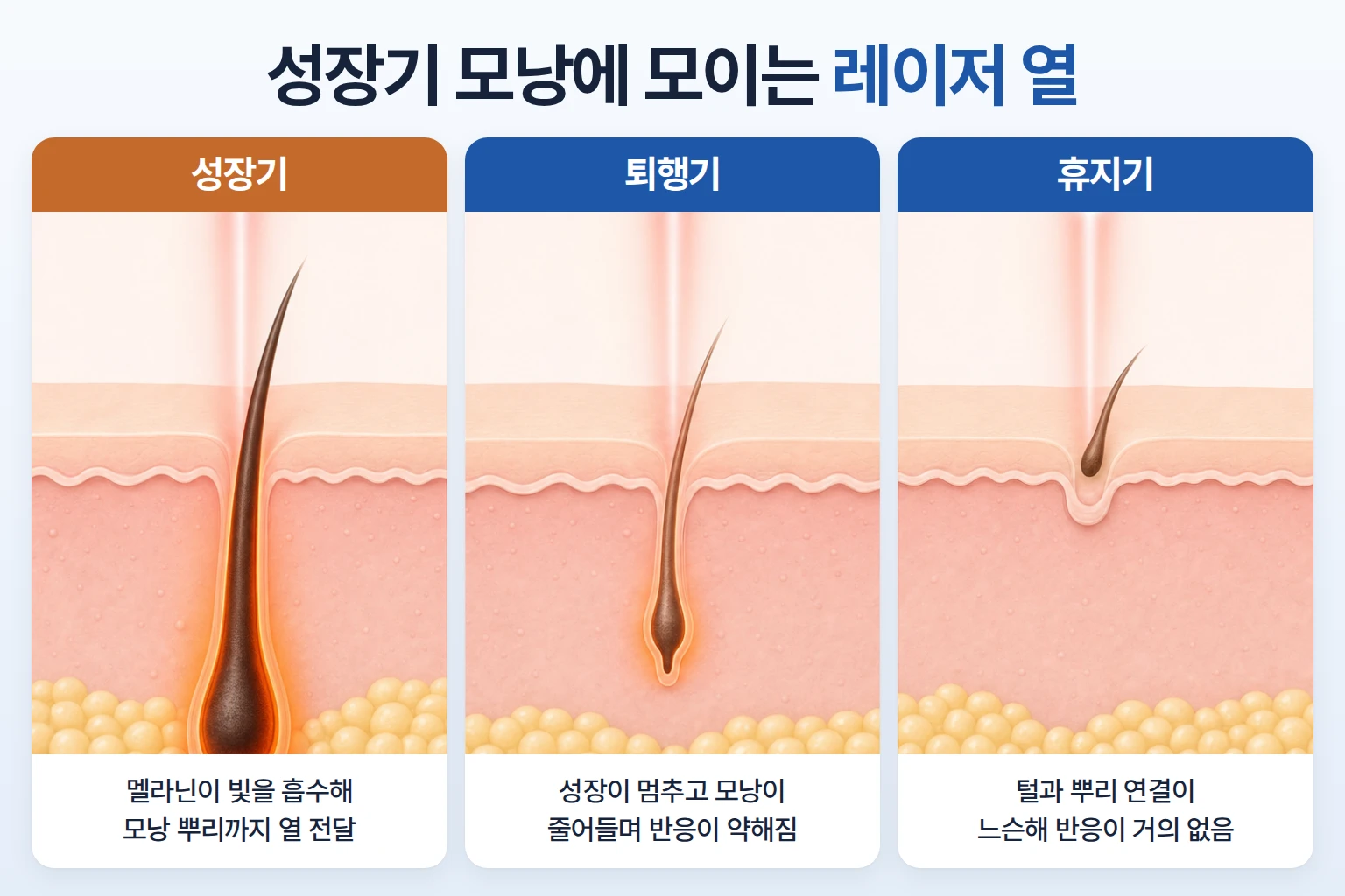 성장기, 퇴행기, 휴지기 모낭 가운데 성장기 모낭 멜라닌에 레이저 열이 모이는 단면 일러스트