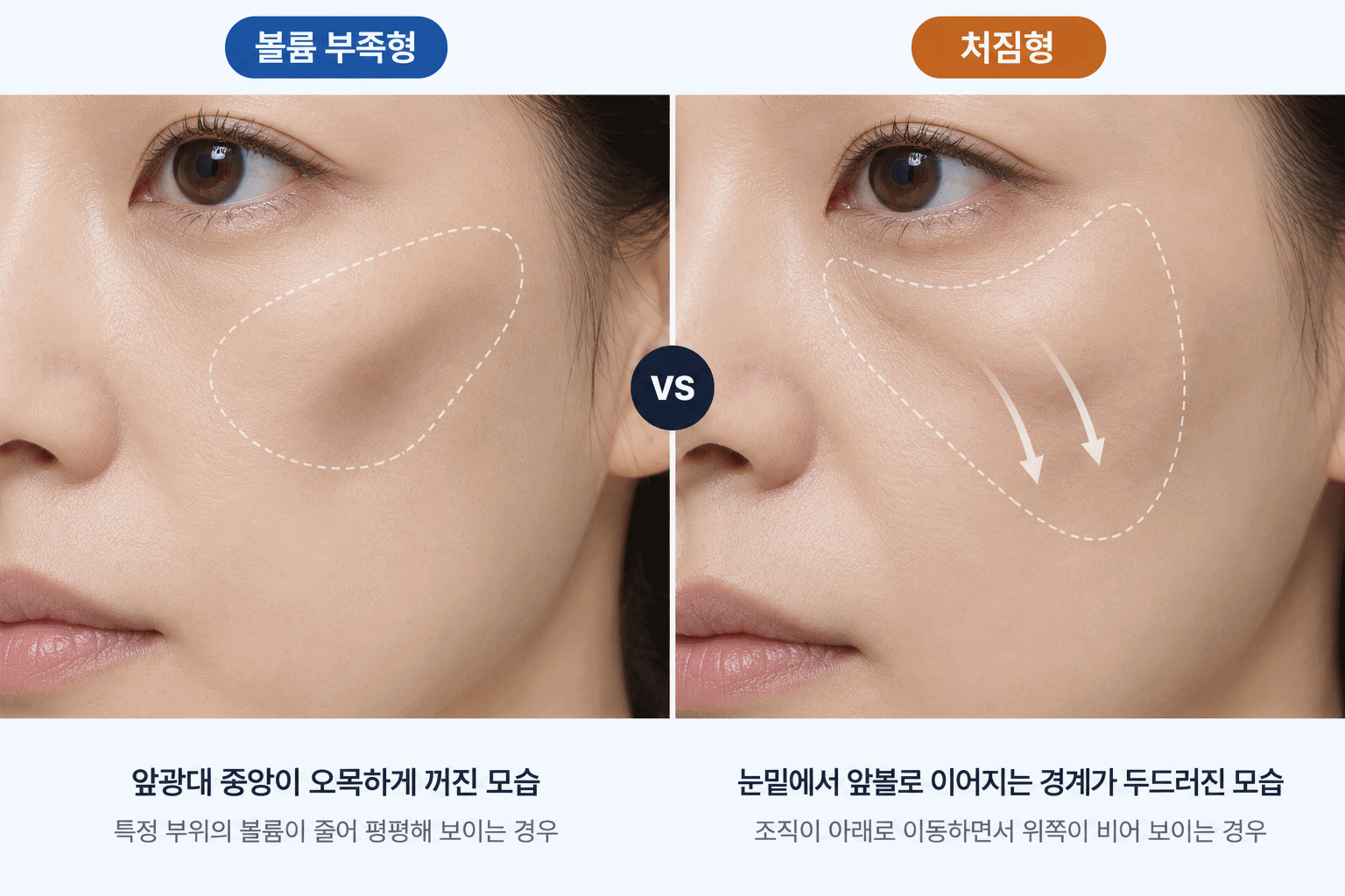 앞광대 꺼짐 볼륨 부족형과 처짐형의 중안면 윤곽 차이