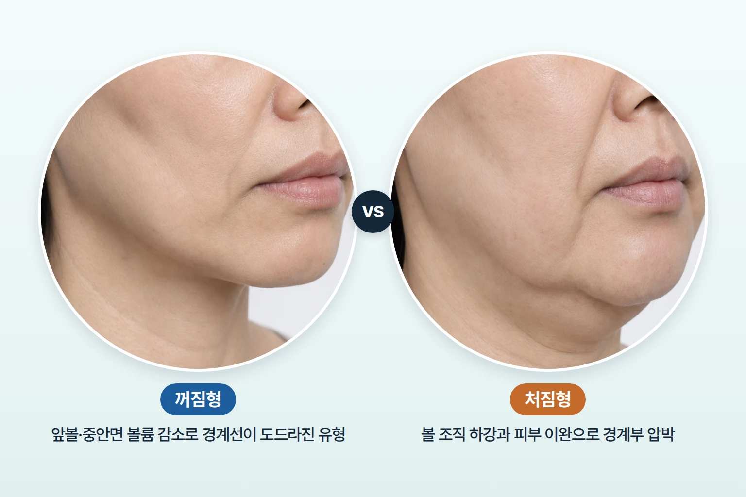 앞볼이 꺼진 유형과 볼 조직이 처진 유형의 팔자 부위 외형을 동일 각도로 비교한 사진