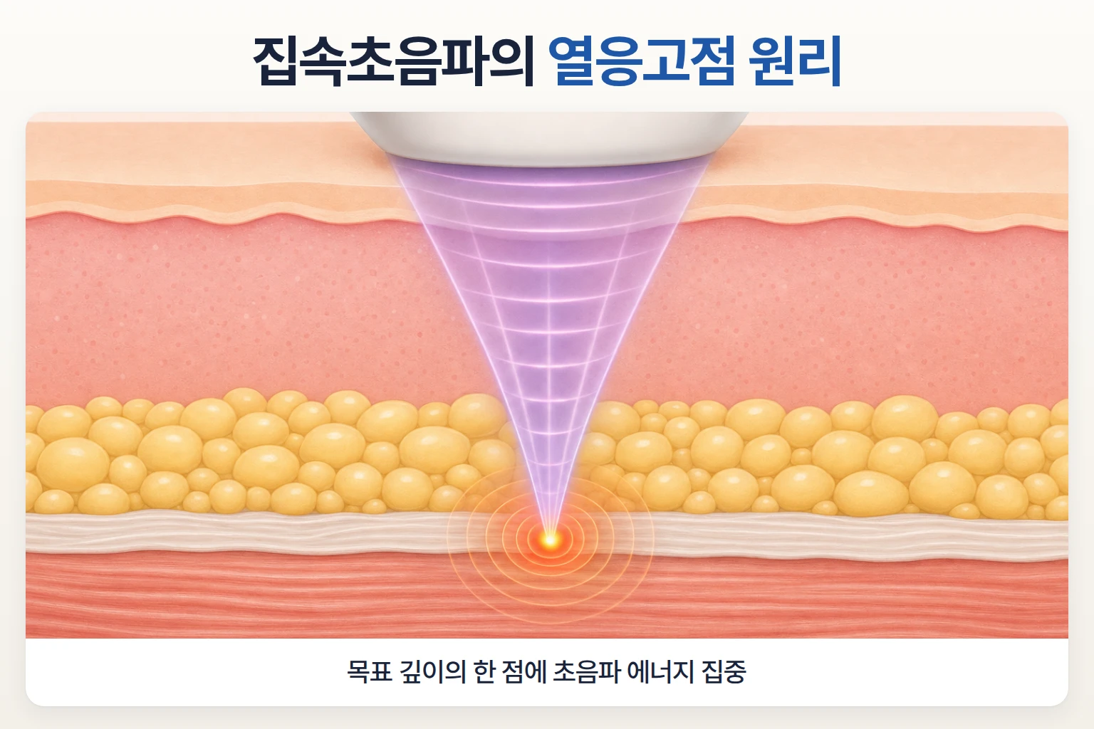 집속초음파가 피부 속 한 지점에 모여 열응고점을 형성하는 구조