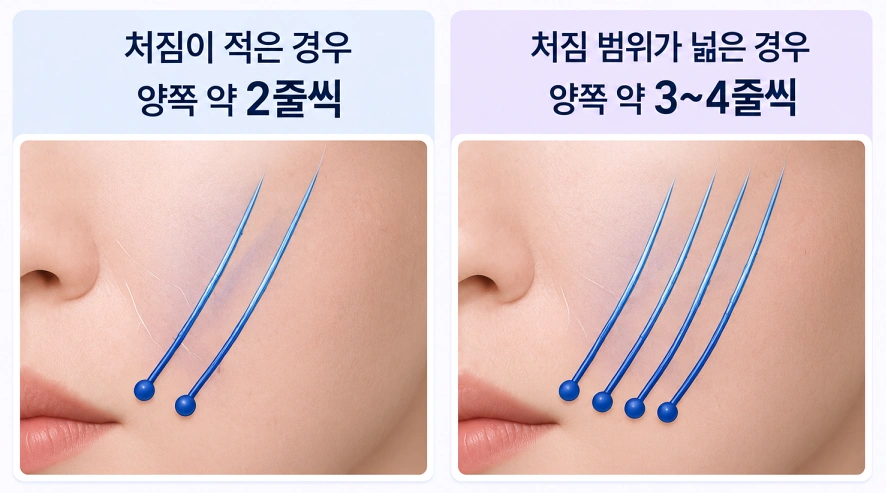 팔자주름의 처짐 범위에 따라 달라지는 실리프팅 적용 개수