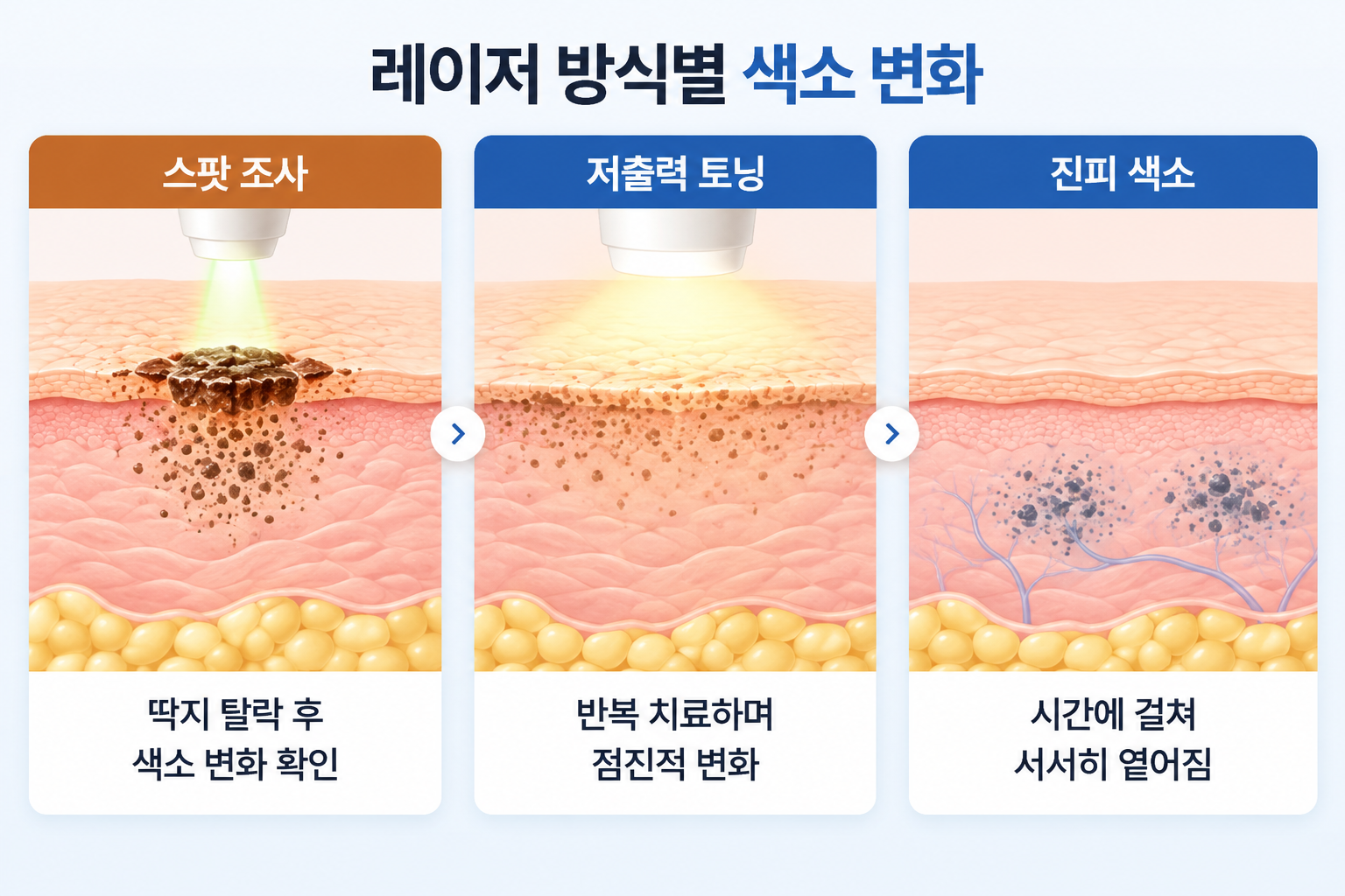 잡티 제거 레이저 스팟 조사 후 딱지 탈락, 저출력 토닝의 반복 치료에 따른 색소 변화, 진피 색소가 서서히 옅어지는 과정