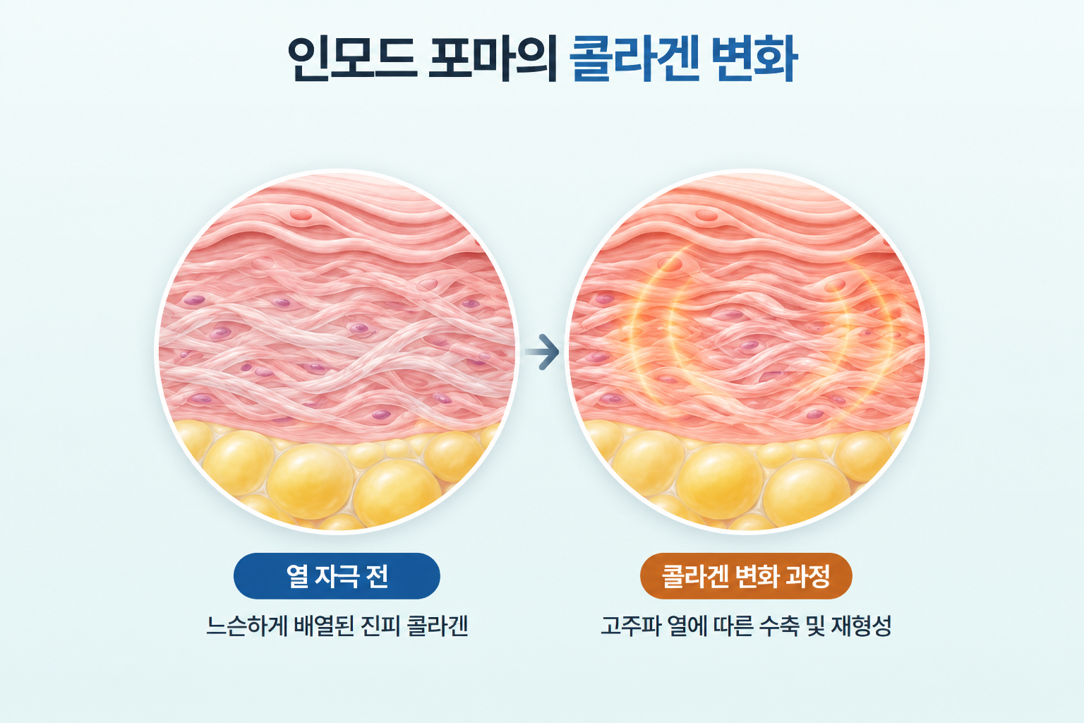 인모드 포마 고주파 열 자극 전 느슨한 진피 콜라겐과 열 자극에 따른 콜라겐 수축 및 재형성 과정 비교