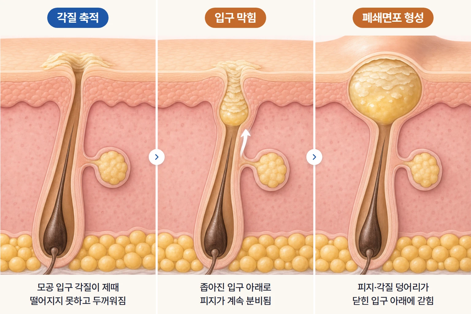 좁쌀여드름이 생기는 원인인 모공 입구의 각질 축적, 피지 배출을 방해하는 입구 막힘, 피지와 각질이 갇힌 폐쇄면포 형성 과정