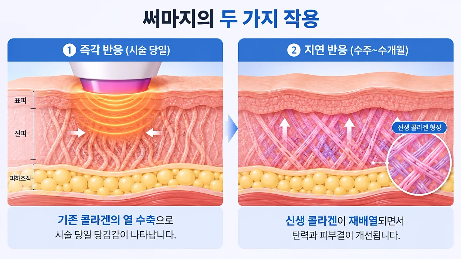 진피에 전달된 고주파 열로 콜라겐이 수축하고 섬유아세포가 활성화되는 과정을 그린 단면 모식도