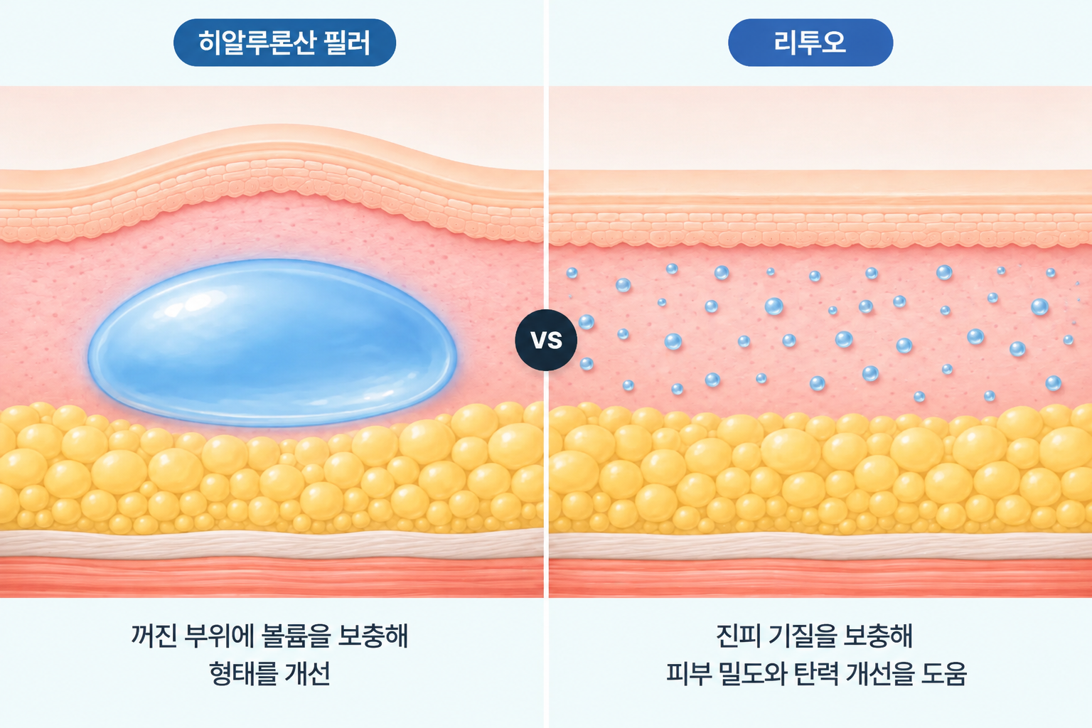 히알루론산 필러의 젤 형태 볼륨 보충과 리투오의 진피 기질 분산 주입을 비교한 피부 단면 구조