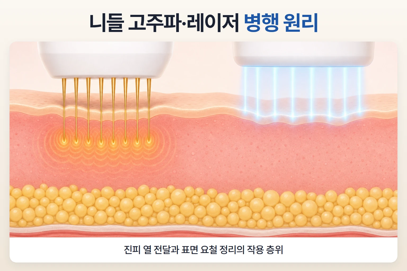 니들 고주파의 진피 열 전달과 레이저의 표면 요철 조사를 한 단면에 함께 나타낸 병행 원리 일러스트