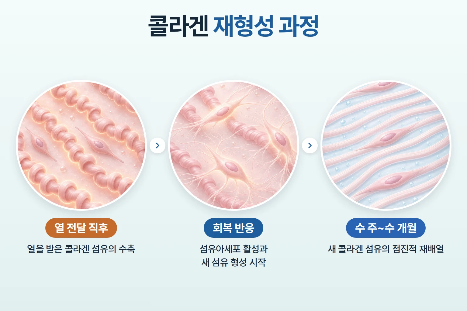 고주파 열 전달 후 콜라겐 수축과 회복 반응을 거치는 재형성 과정