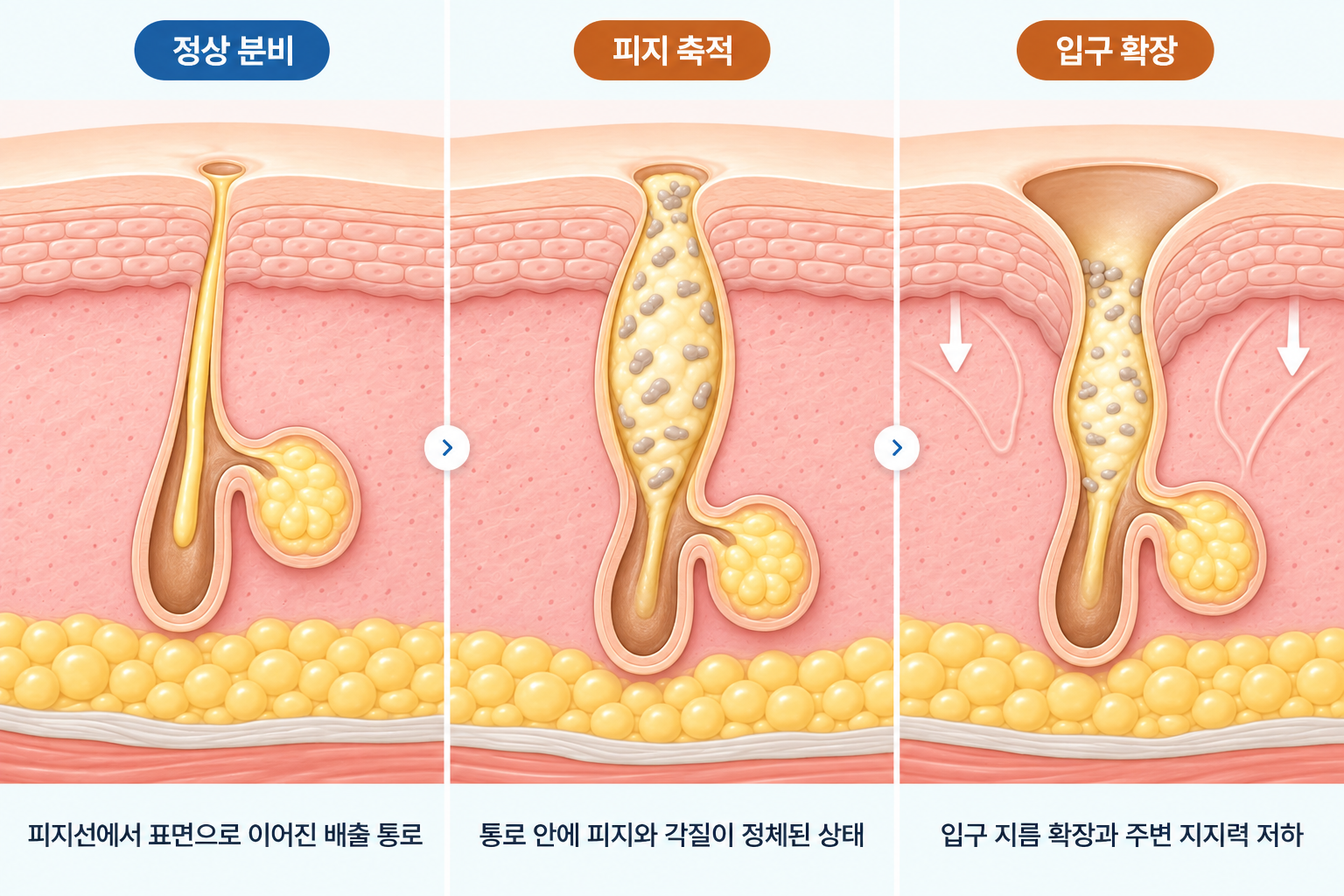 피지 축적에 따라 모공 입구가 넓어지는 과정