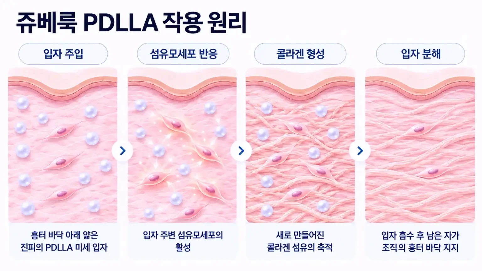 PDLLA 입자 주변 섬유모세포가 반응해 콜라겐을 만드는 과정을 단계별로 나타낸 개념도