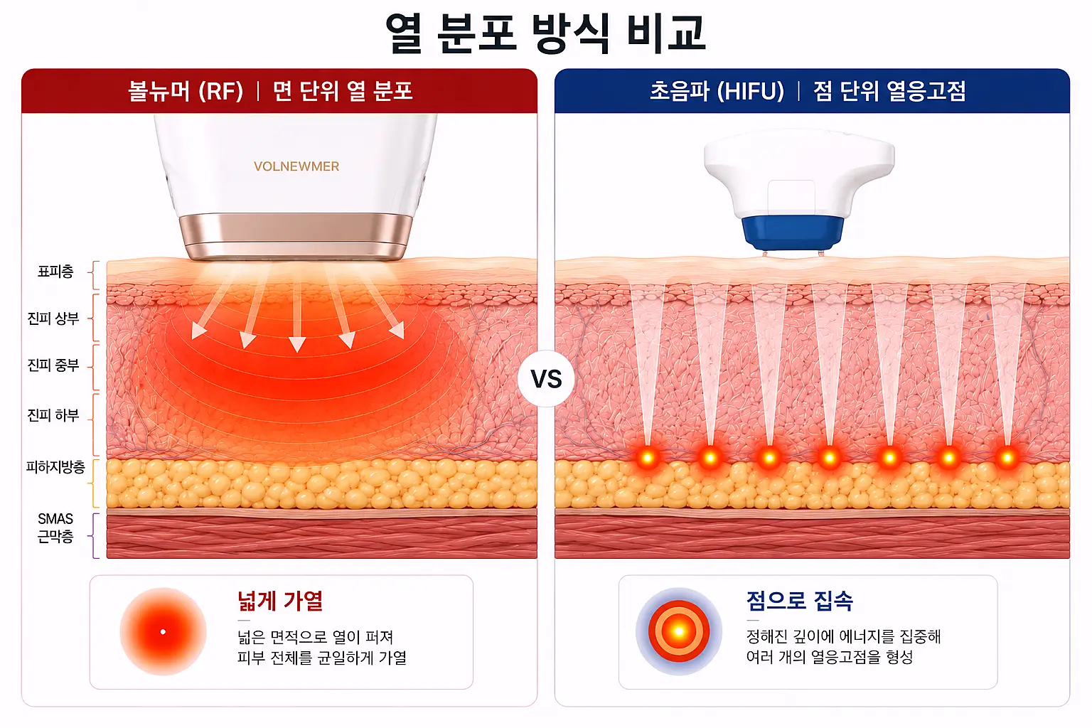 고주파 면 단위 열 분포와 초음파 점 단위 열응고점 비교 단면도