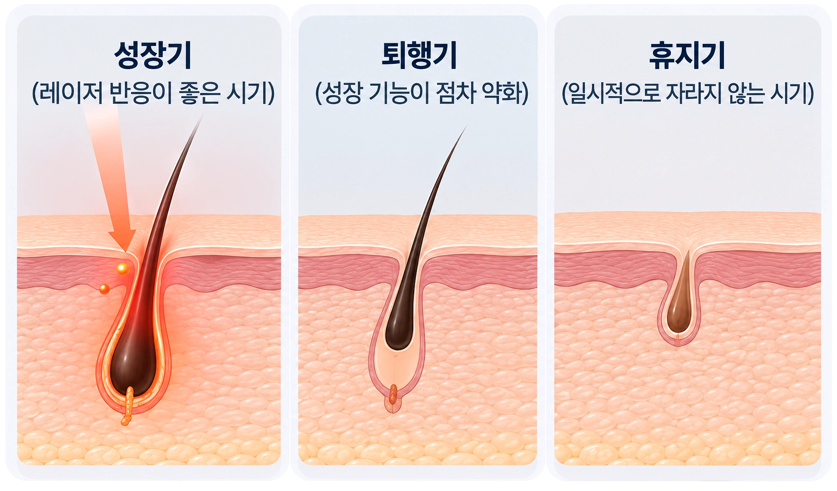 레이저 제모 전 살펴보는 모발 성장기·퇴행기·휴지기