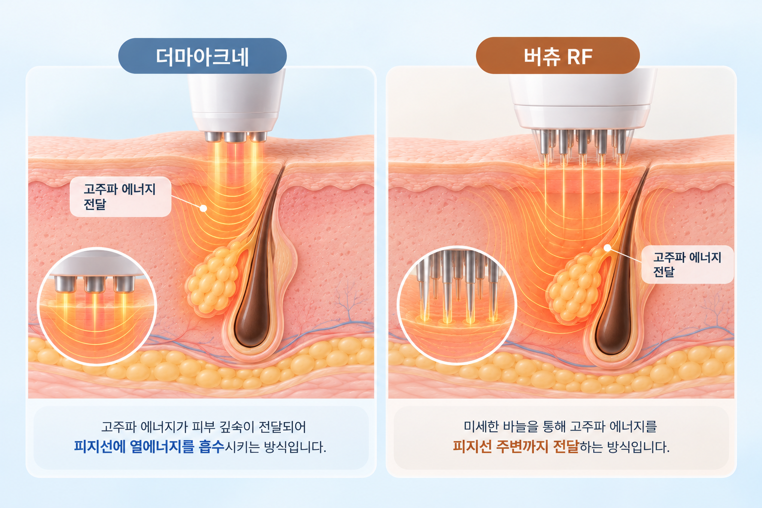 더마아크네와 버츄 RF의 고주파 에너지 전달 구조 비교