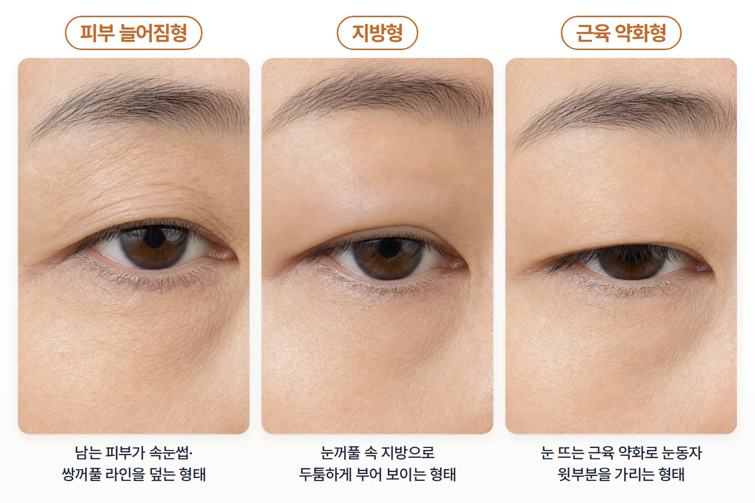 피부 늘어짐형, 지방형, 근육 약화형 윗눈꺼풀 처짐 모습을 같은 각도로 나란히 비교한 눈가 사진