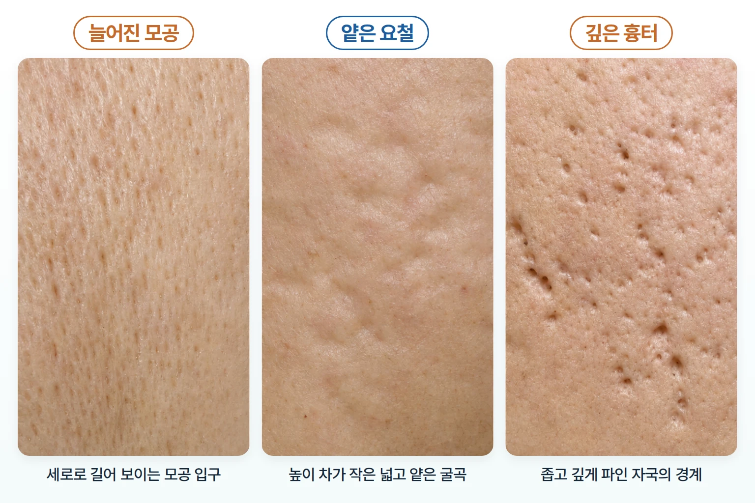 늘어진 모공, 얕은 요철, 깊게 파인 흉터의 표면 형태를 같은 배율로 담은 비교 사진