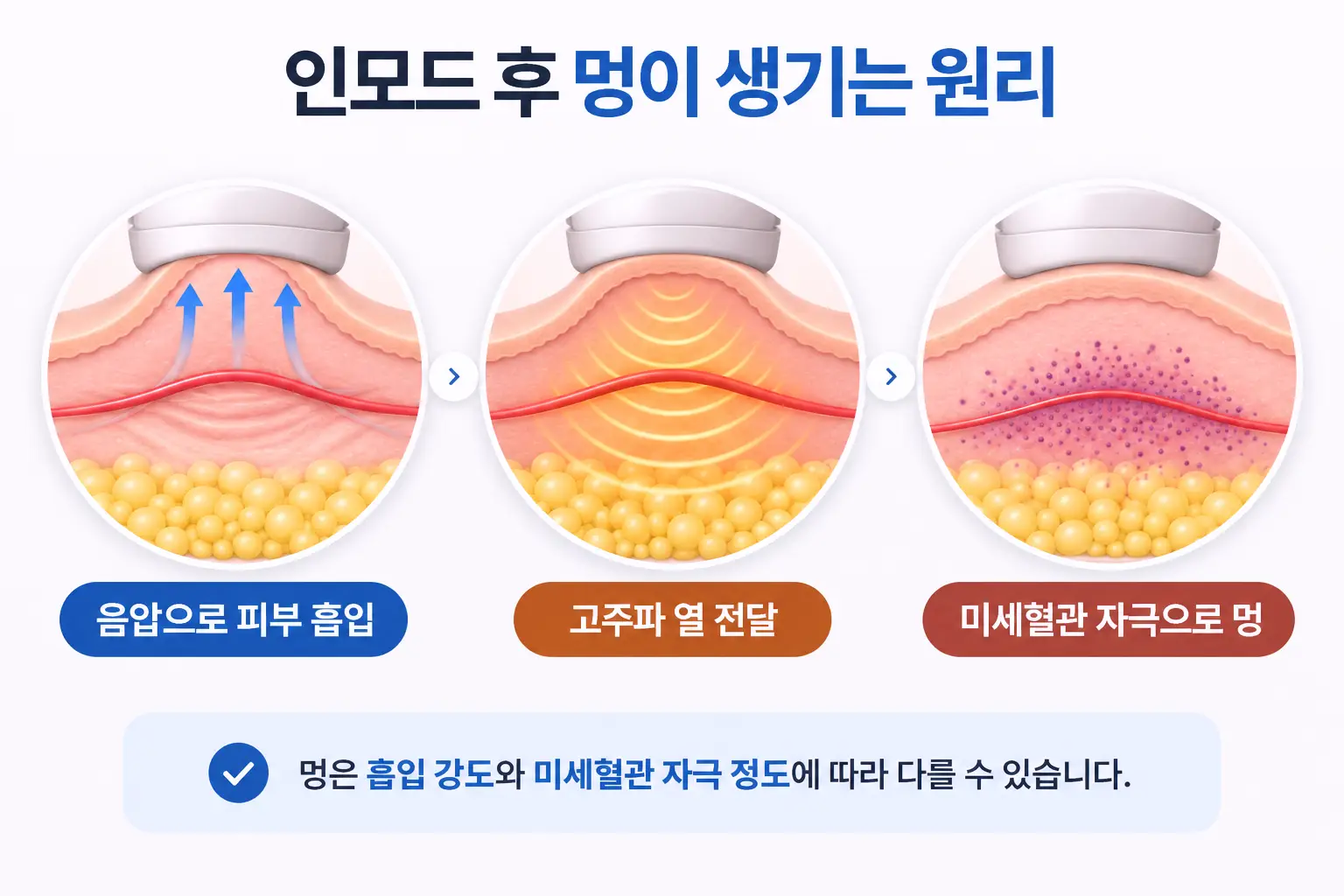 인모드 음압 흡입으로 들린 피부 속 미세혈관에 압력과 열이 전달되는 과정을 그린 단면 일러스트