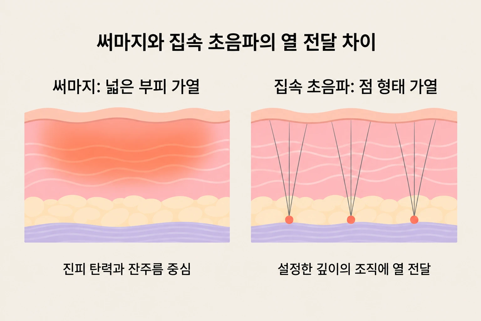 넓은 조직을 가열하는 써마지와 설정한 깊이에 열을 모으는 집속 초음파 비교