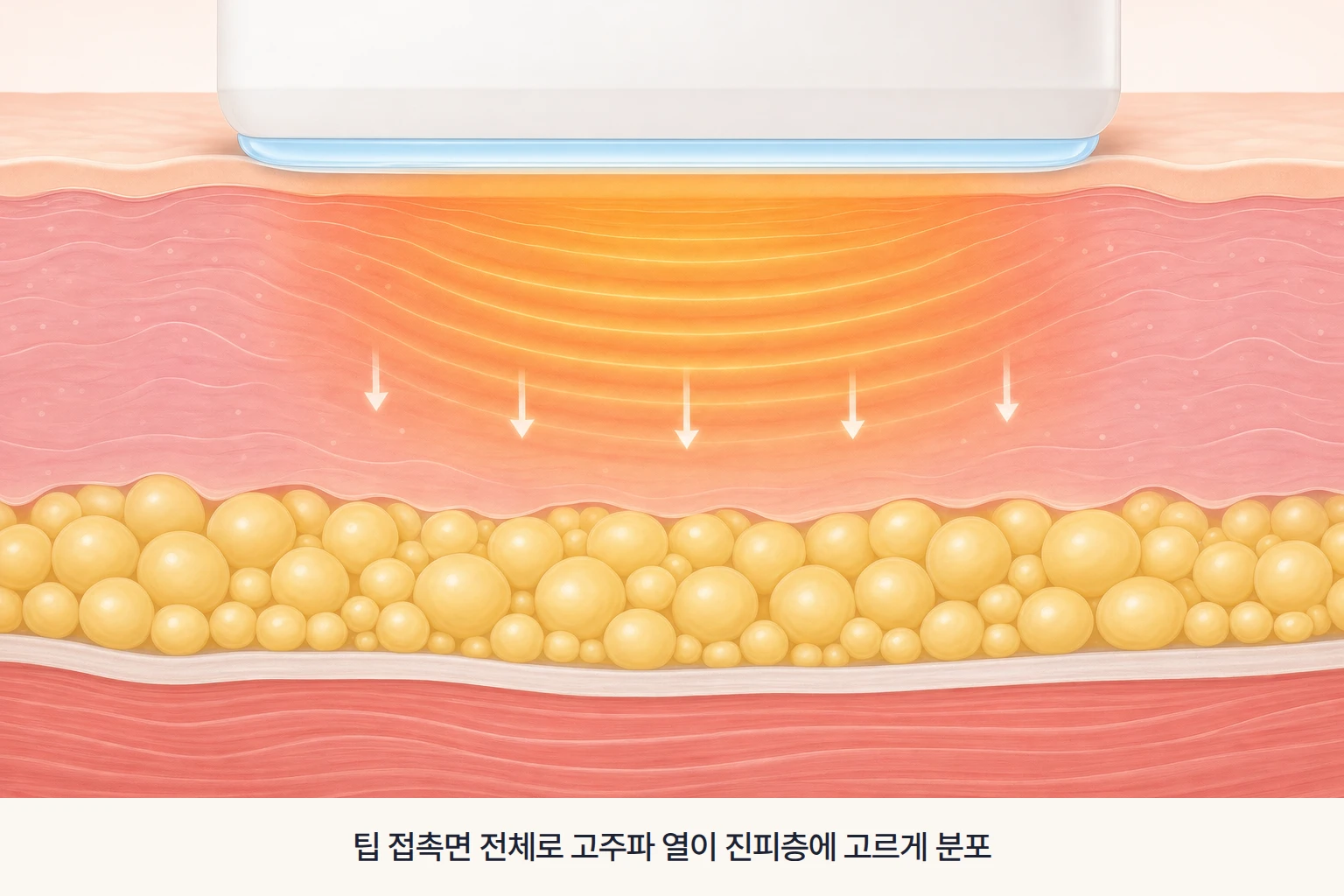 써마지 팁이 피부 표면에 닿아 고주파 열이 진피 깊이까지 고르게 퍼지는 모습을 그린 개념도