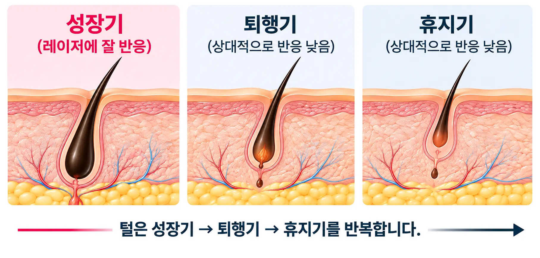성장기 모발을 중심으로 진행하는 레이저 제모