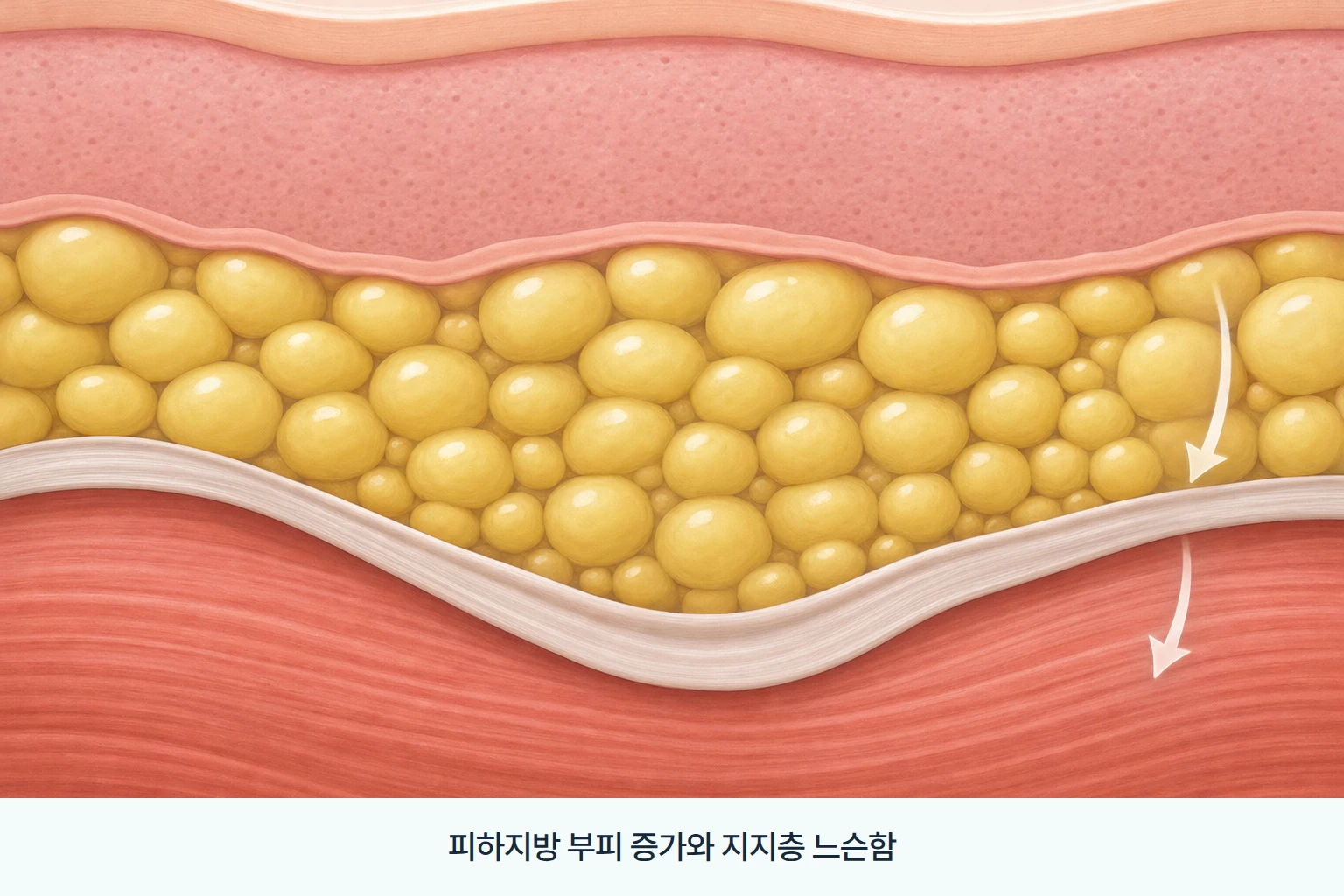 피하지방 증가와 근막층 지지력 저하가 겹친 하안면 구조를 나타낸 피부 단면 일러스트