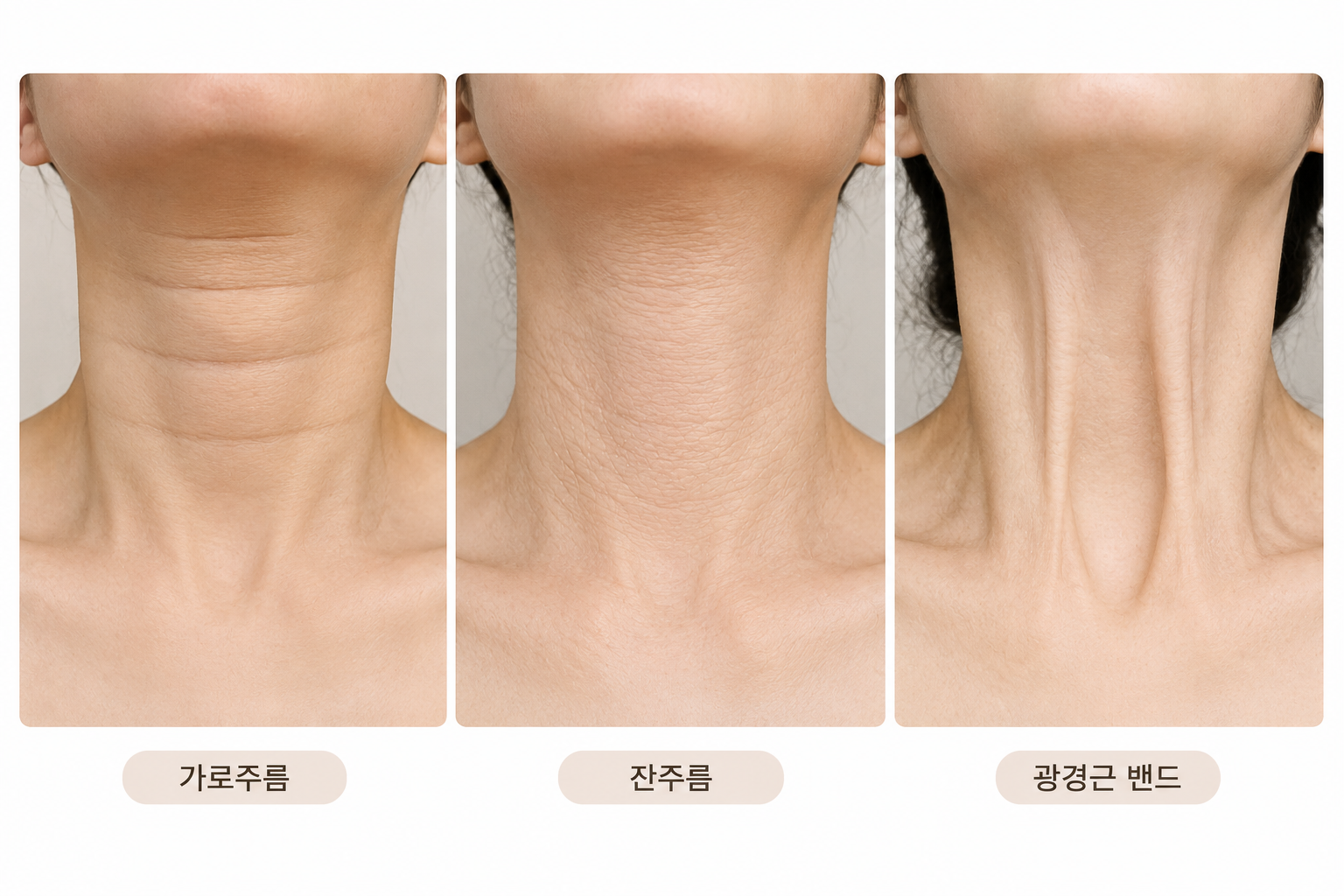 목의 가로주름과 잔주름, 광경근 밴드 형태를 3분할로 비교한 도해