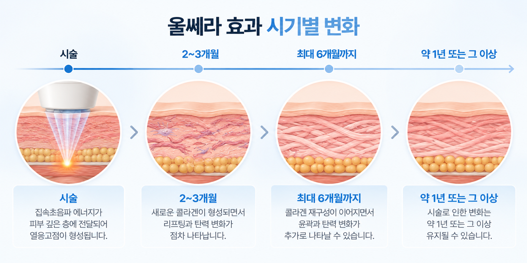 울쎄라 효과가 2~3개월부터 나타나 최대 6개월까지 이어지고 약 1년 이상 유지되는 과정