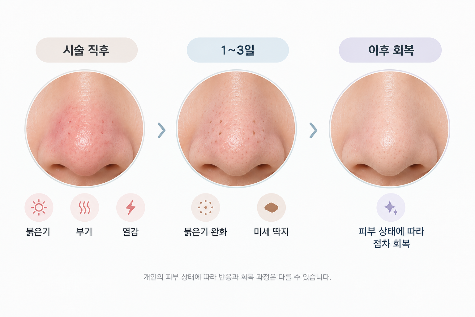 코 피지선증식증 치료 직후부터 1~3일 이후까지 붉은기와 미세 딱지의 회복 과정
