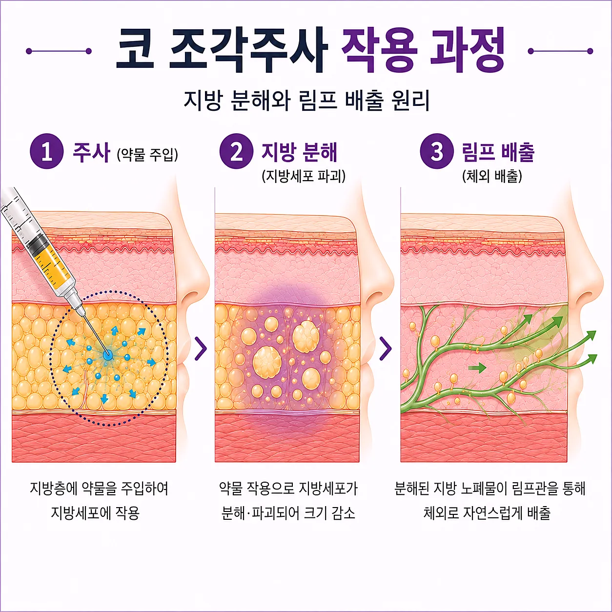 코 조각주사 작용 과정 - 지방 분해와 림프 배출