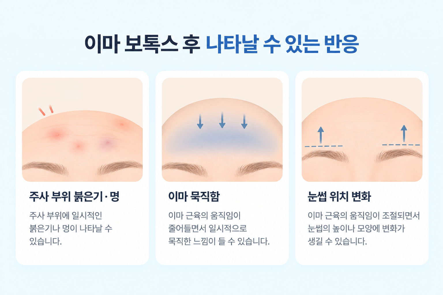 이마 주름 보톡스 후 주사 부위 붉은기와 이마 묵직함 눈썹 위치 변화