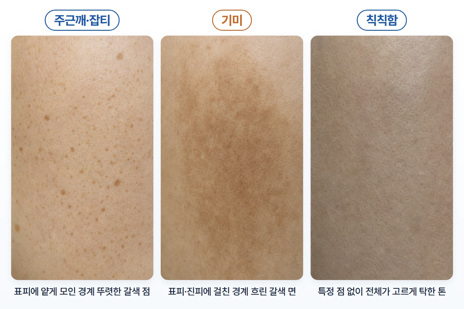 주근깨와 잡티 기미 칙칙한 피부톤의 외형 차이를 비교한 피부 표면