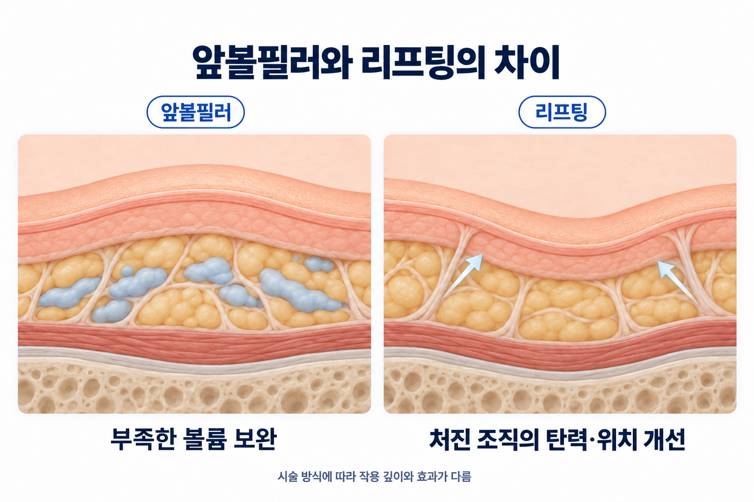 앞볼필러와 리프팅 시술의 작용 방식 및 개선 원리를 비교한 피부 단면도