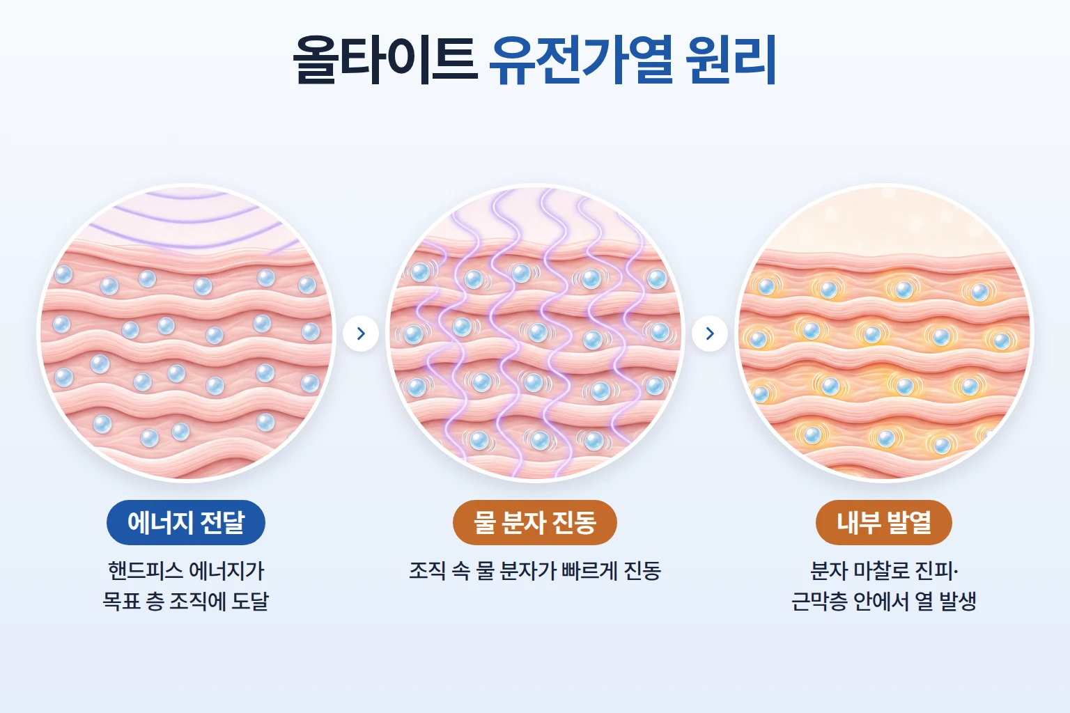 유전가열 에너지에 물 분자가 진동하며 진피와 근막층 안에서 열이 생기는 과정을 3단계로 그린 개념도