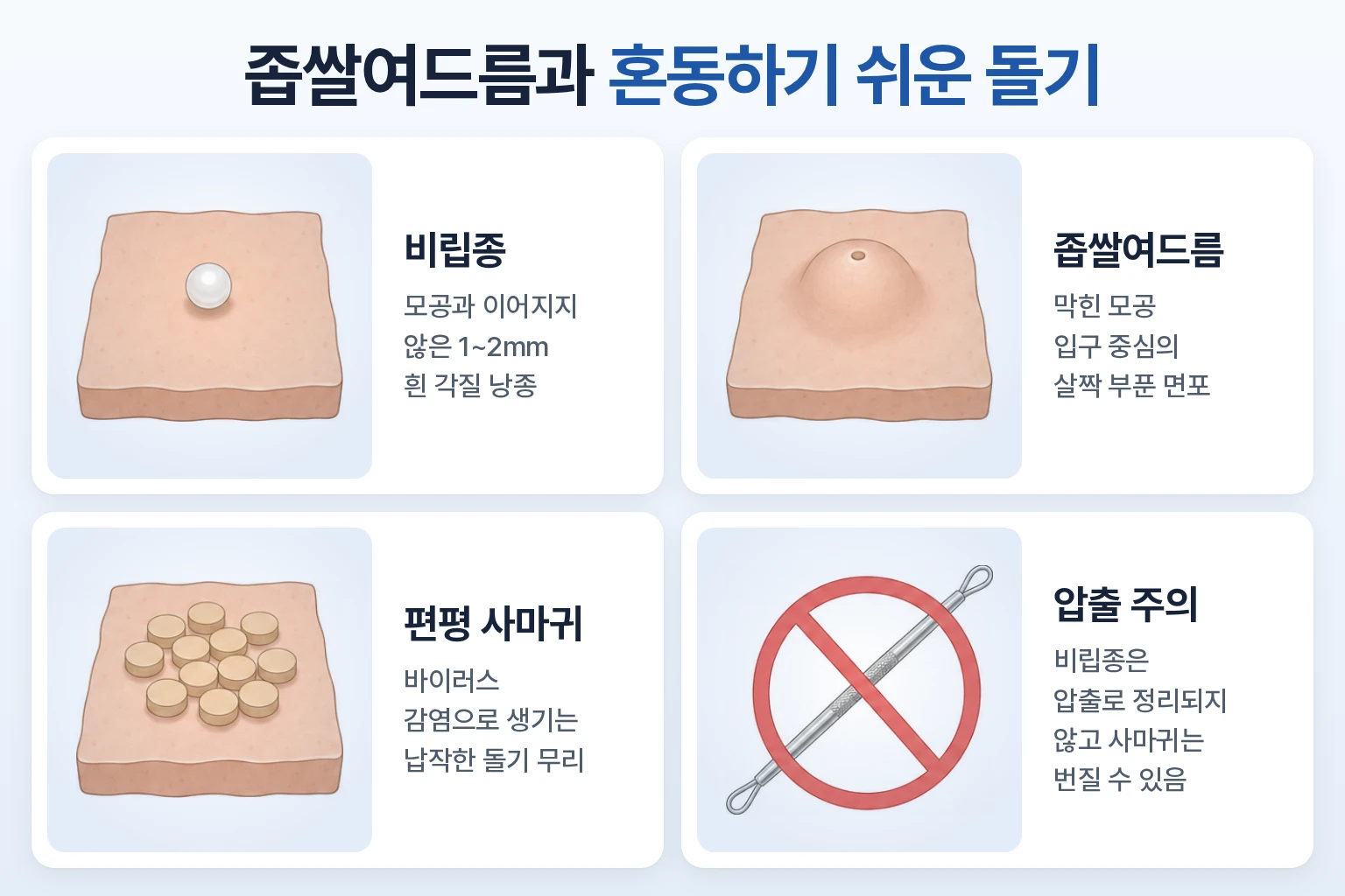 좁쌀여드름의 막힌 모공 중심 돌기, 비립종의 흰 각질 낭종, 편평사마귀의 납작한 돌기 특징과 무리한 압출 주의사항