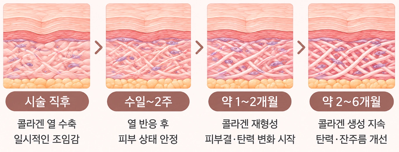 써마지 시술 직후부터 2~6개월까지 콜라겐 변화 과정을 나타낸 피부 단면도