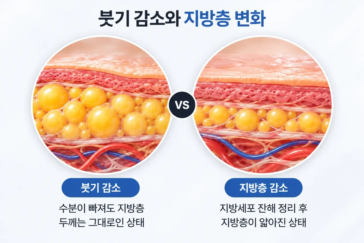 시술 후 붓기만 빠진 상태와 지방층 두께가 줄어든 상태를 같은 배율로 나란히 비교한 턱선 단면도